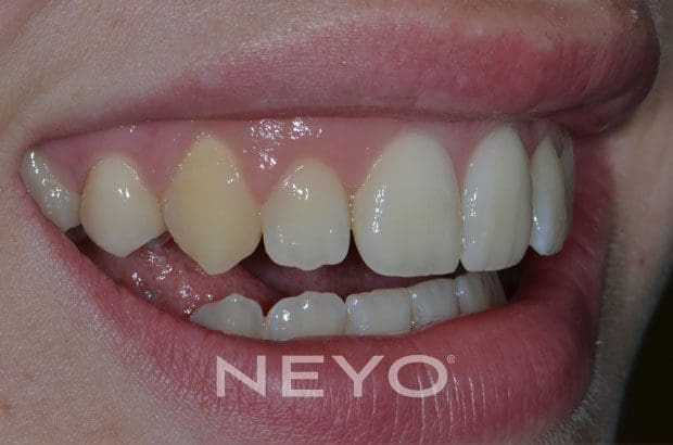 NEYO Dental specialist - Gumlift After