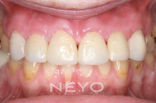 NEYO Dental specialist - Gumlift After