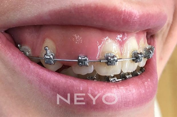 NEYO Dental specialist - Gumlift Before