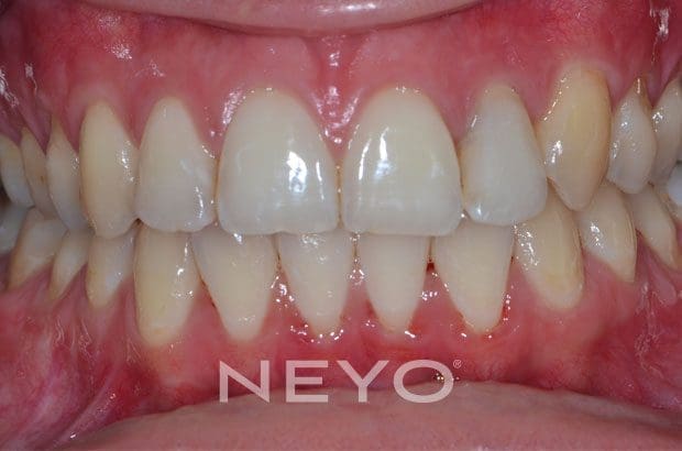NEYO Dental specialist - Gum regeneration After