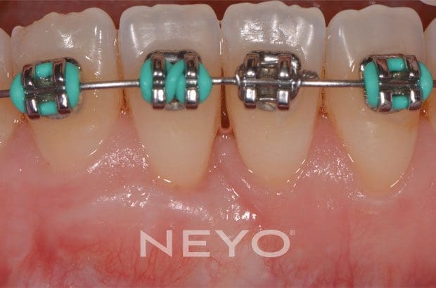 NEYO Dental specialist - Gum regeneration After