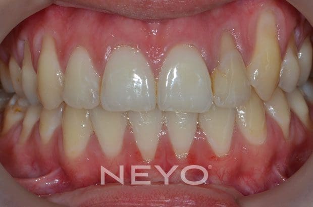 NEYO Dental specialist - Gum regeneration Before