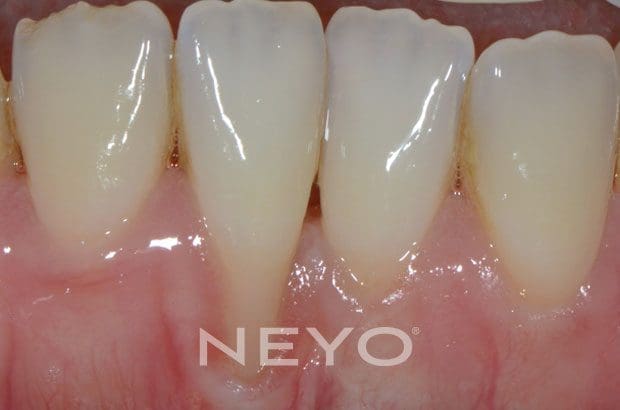 NEYO Dental specialist - Gum regeneration Before