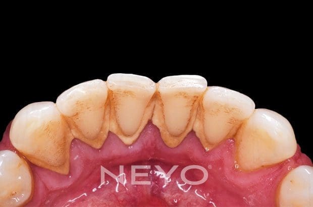 NEYO Dental specialist - Hygienist Before