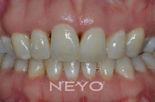 NEYO Dental specialist - Periodontal Deep Cleaning Before