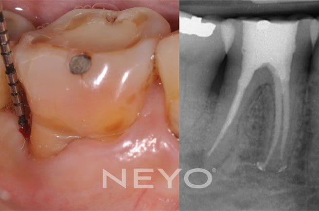 NEYO Dental specialist - Periodontal Regeneration After