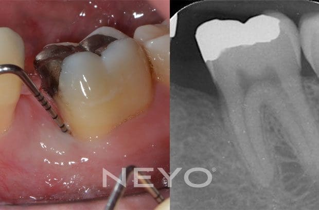 NEYO Dental specialist - Periodontal Regeneration After