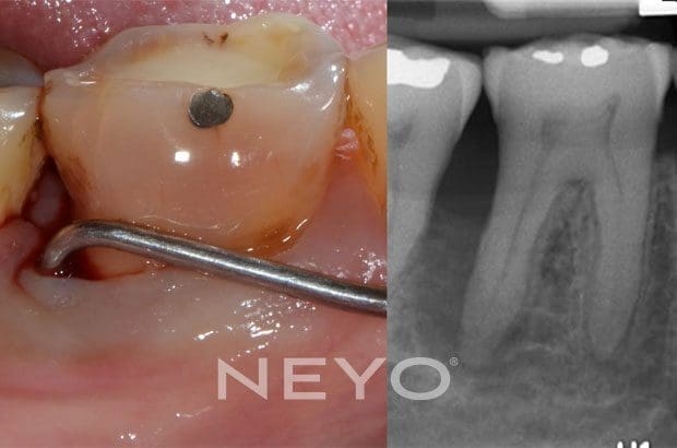 NEYO Dental specialist - Periodontal Regeneration Before
