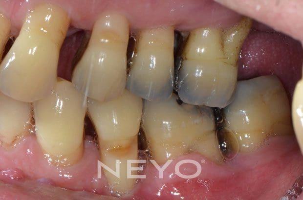 NEYO Dental specialist - Periodontal Surgery After