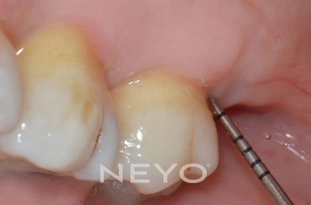 NEYO Dental specialist - Periodontal Surgery After