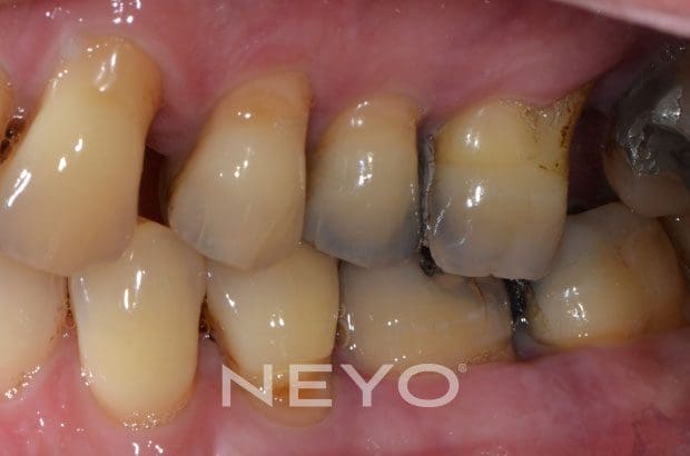 NEYO Dental specialist - Periodontal Surgery Before