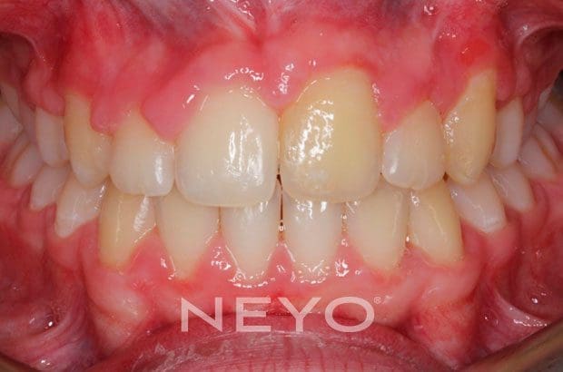 Neyo Dental Specialist - Alignment of Impacted Teeth After
