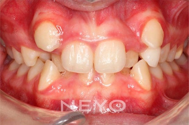 Neyo Dental Specialist - Alignment of Impacted Teeth Before