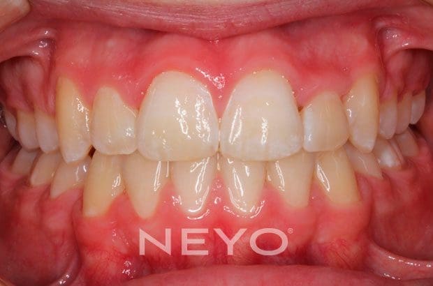 Neyo Dental Specialist - Clear Braces After