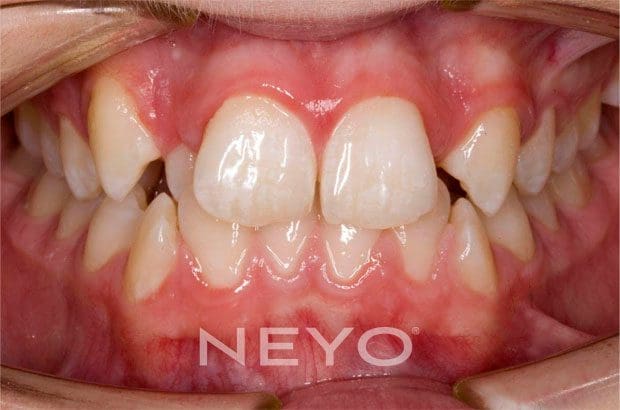 Neyo Dental Specialist - Clear Braces Before