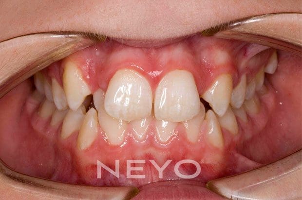 Neyo Dental Specialist - Crooked Teeth