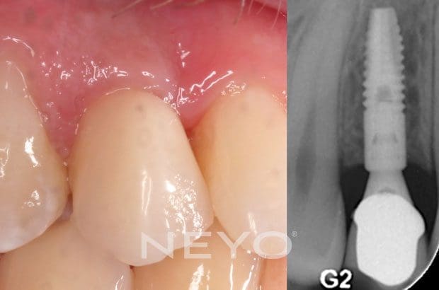 Neyo Dental Specialist - Dental Implants Removal After