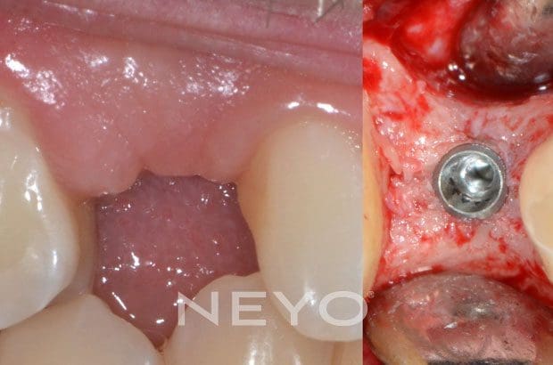 Neyo Dental Specialist - Dental Implants Removal Before