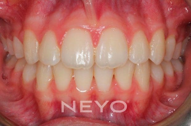 Neyo Dental Specialist - Forsus Springs After