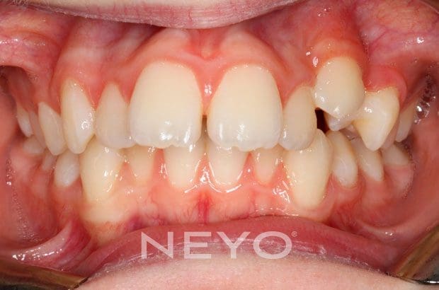 Neyo Dental Specialist - Forsus Springs Before