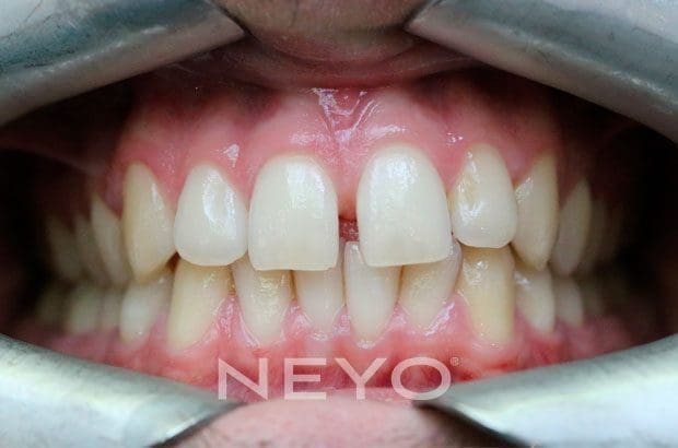 Neyo Dental Specialist - Gappy Teeth