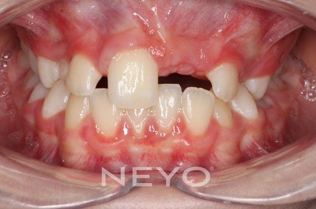 Neyo Dental Specialist - Impacted Teeth