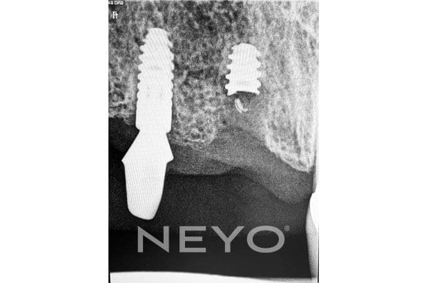 Neyo Dental Specialist - Implant Complications