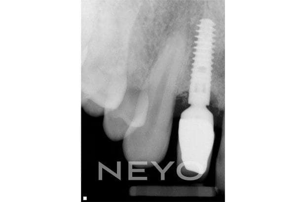 Neyo Dental Specialist - Implant Deep Clean After