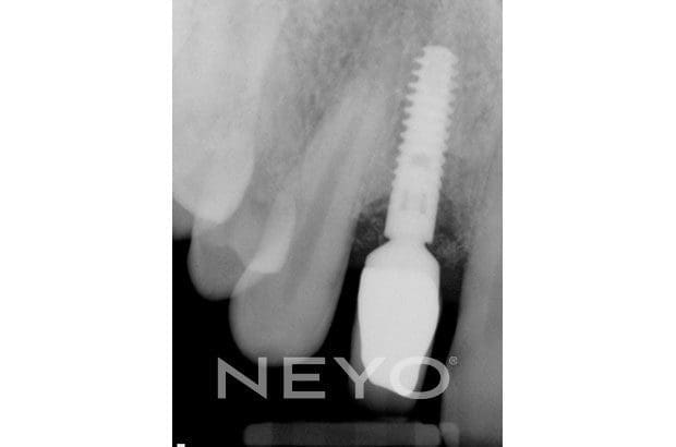 Neyo Dental Specialist - Implant Deep Clean Before