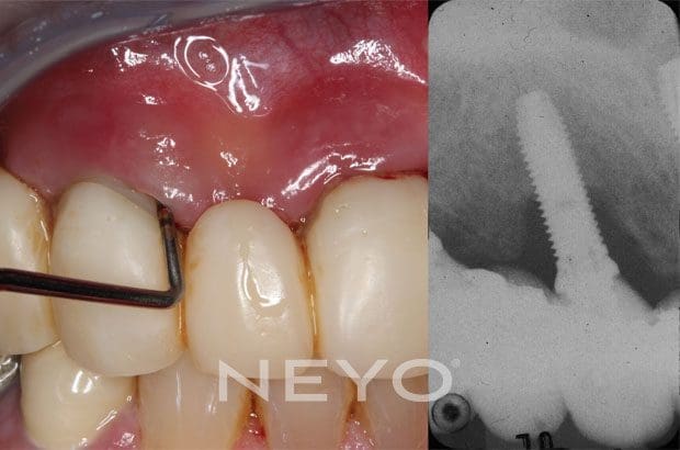 Neyo Dental Specialist - Implant Infections