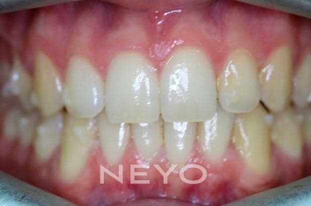 Neyo Dental Specialist - Invisalign Adult After
