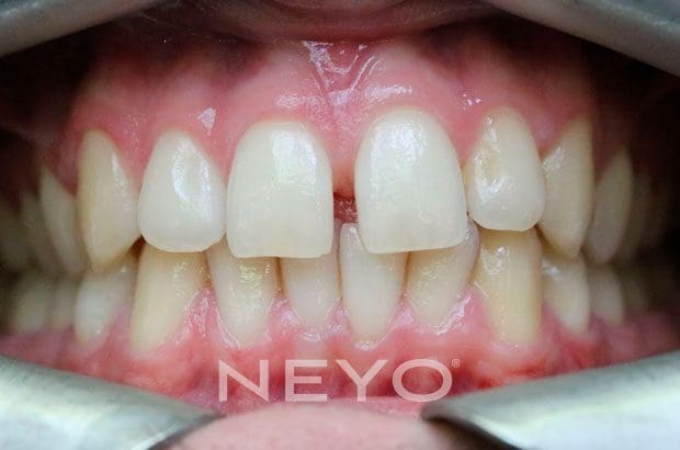 Neyo Dental Specialist - Invisalign Adult Before