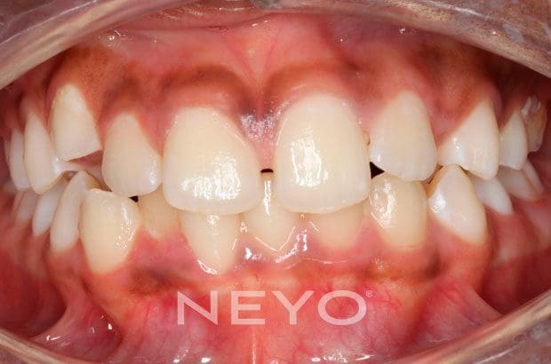 Neyo Dental Specialist - Metal Braces Before