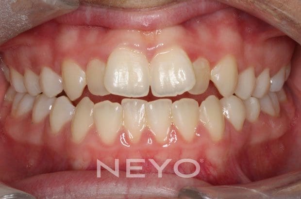 Neyo Dental Specialist - Openbite