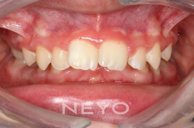 Neyo Dental Specialist - Overbite