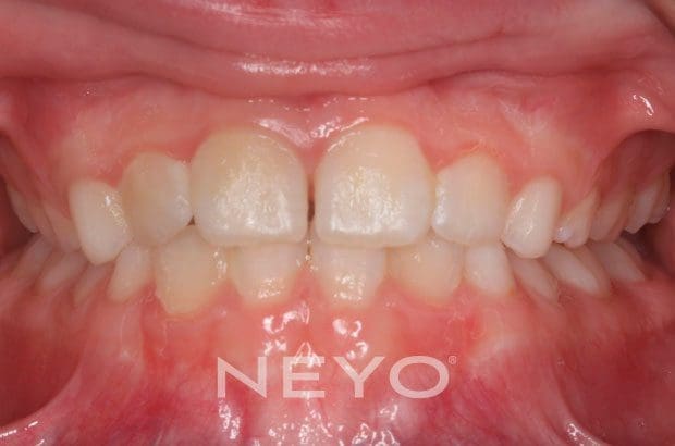 Neyo Dental Specialist - Removable Braces After