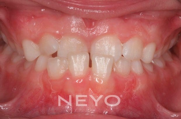 Neyo Dental Specialist - Removable Braces Before