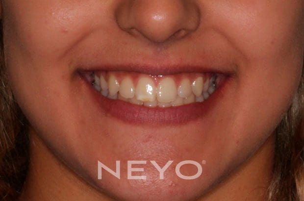 Neyo Dental Specialist - Twin Blocks After