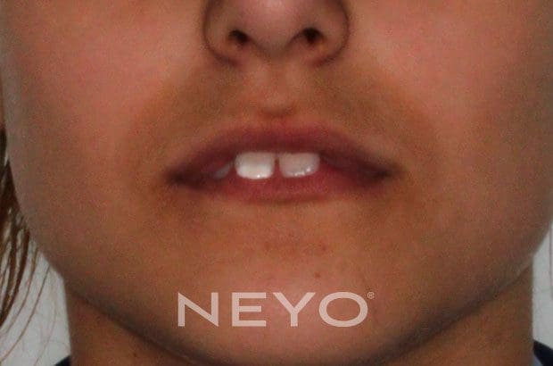 Neyo Dental Specialist - Twin Blocks Before
