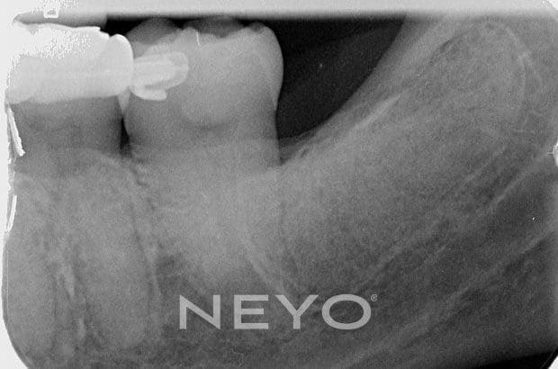 Neyo Dental Specialist - Wisdom Tooth Removal After