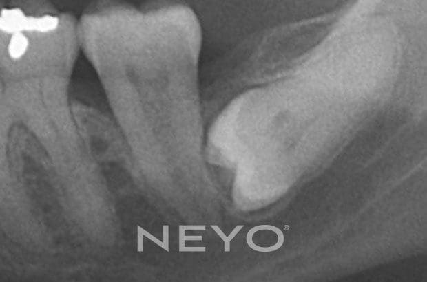 Neyo Dental Specialist - Wisdom Tooth Removal Before
