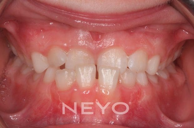 Neyo Dental Specialist - underbite