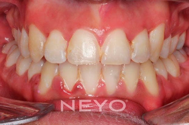 Neyo Dental Specialist - Adult Braces After