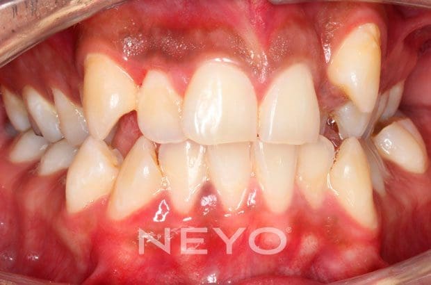 Neyo Dental Specialist - Adult Braces Before