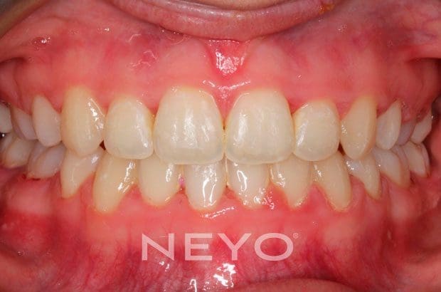 Neyo Dental Specialist - Invisalign Teen After