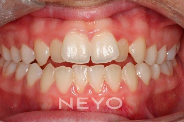 Neyo Dental Specialist - Invisalign Teen Before