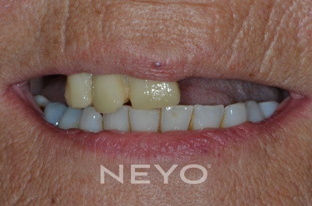 Neyo Dental Specialist - Missing Teeth