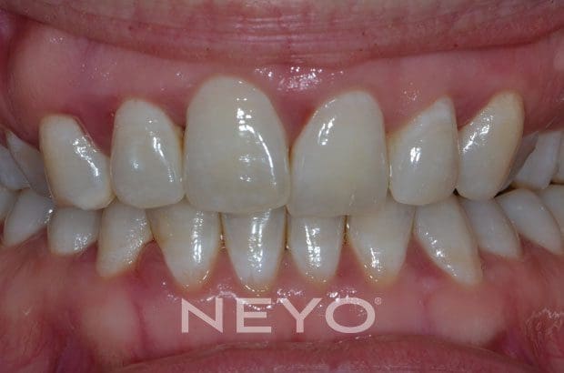 Neyo Dental Specialist - Periodontitis