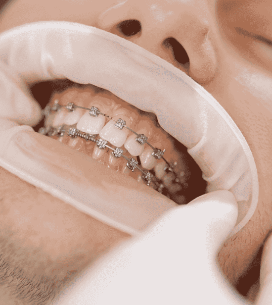 Braces and Orthodontics West Sussex