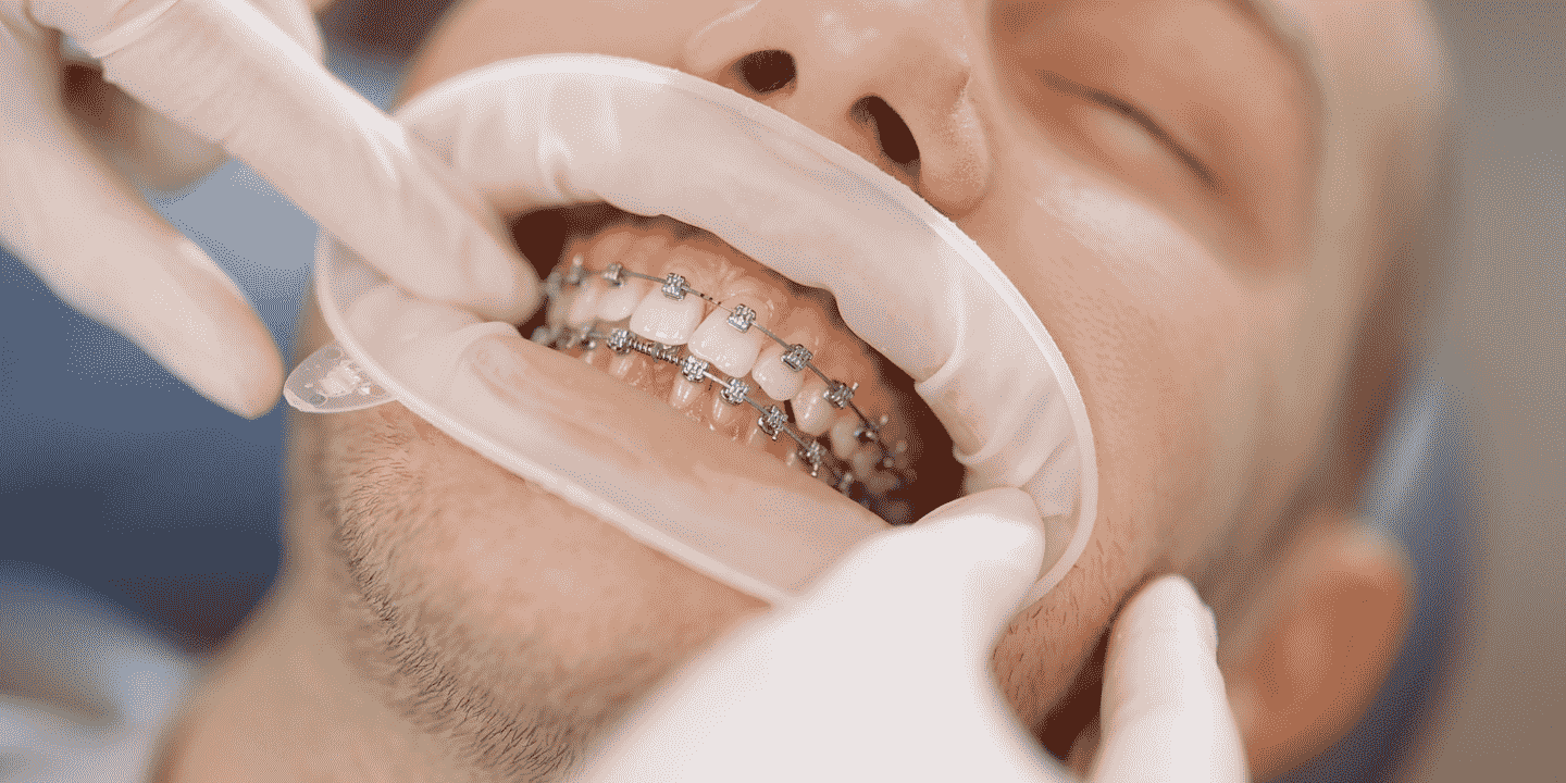 Braces and Orthodontics West Sussex